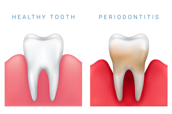 Image of healthy tooth and gum diesease tooth