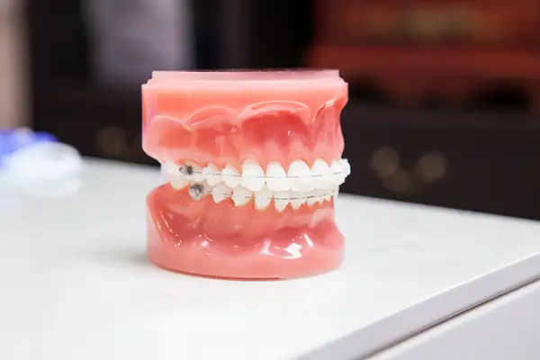 A dental model featuring clear braces, displayed on a countertop in a clinic setting for orthodontic demonstration. 