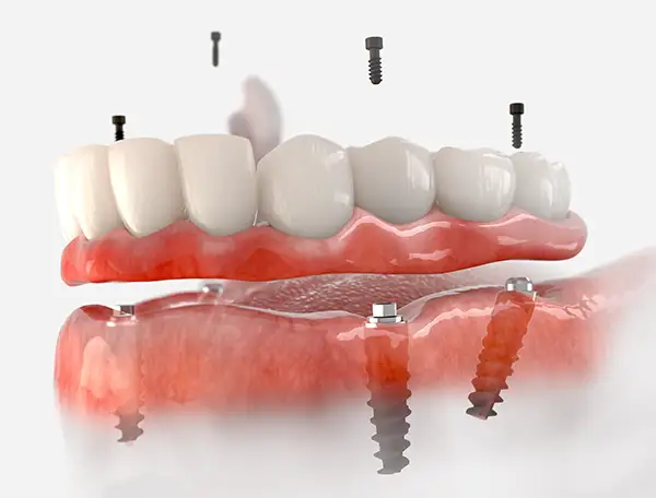 An upper arch implant-supported denture being secured with titanium screws.