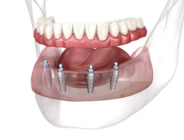 A lower jaw with implant-supported dentures attached to titanium implants for enhanced stability.