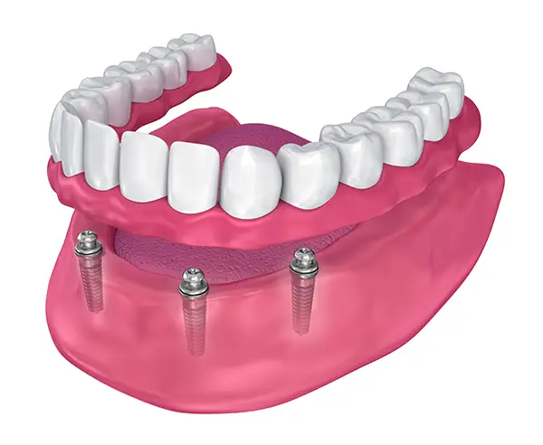 A full-arch denture supported by four dental implants in the lower jaw.